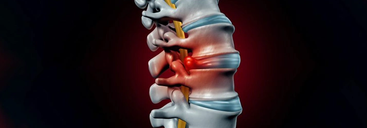 disc injury can be helped by a chiropractor